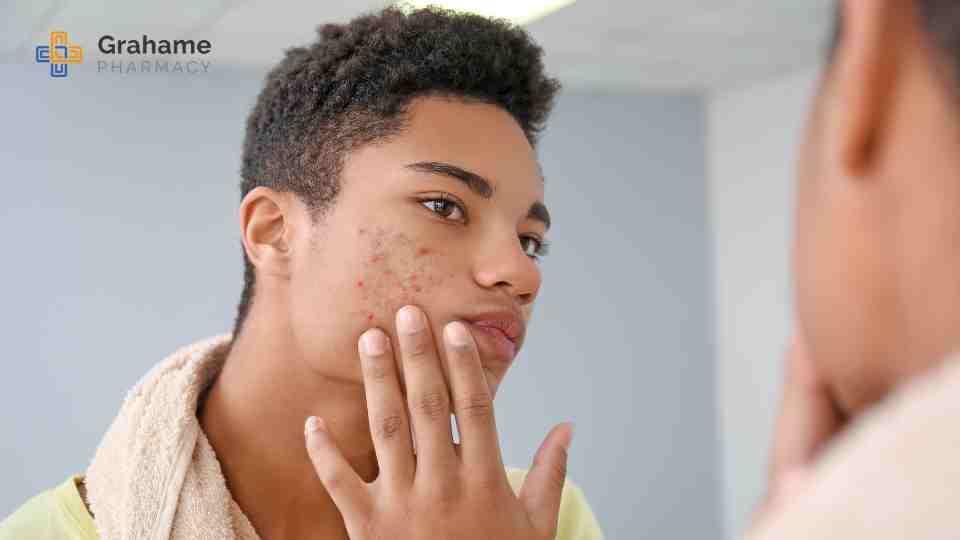 best acne treatment in lisburn